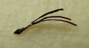 Types of folliculitis include razor bumps, hot tub rash, and barber's itch. Pili Multigemini Wikipedia