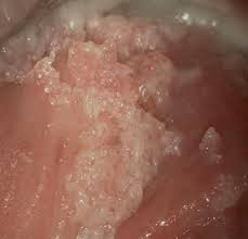 Human papilloma viruses (hpv) can be detected in different epithelia with the help of the polymerase chain reaction (pcr). Humane Papillomviren Hpv Prof Dr Med Werner Mendling