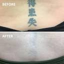 Tattoos: Effective Removal Treatments - SkinCare Physicians