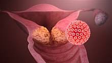 The cervical cancer jab is actually a vaccine against the human papilloma virus. Human Papillomavirus Infection Wikipedia