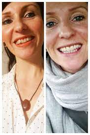Keine brackets und kein draht; Pin Auf Vorher Nachher