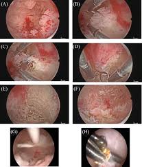 Postmenopausal bleeding is the big one, especially considering that endometrial cancer predominantly affects women over the age of 55. Predictive Accuracy Of Progesterone Receptor B In Young Women With Atypical Endometrial Hyperplasia And Early Endometrial Cancer Treated With Hysteroscopic Resection Plus Lng Iud Insertion Journal Of Minimally Invasive Gynecology