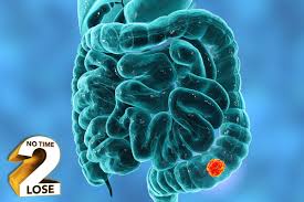 I, for example, have never experienced the weight loss element cologuard detects colon cancer even before it becomes symptomatic. Bowel Cancer Symptoms What Are The Early Warning Signs To Look Out For