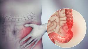 Irritable Bowel Syndrome Wikipedia