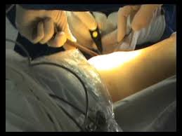 La originea chist endometrioid, una. OperaÅ£ie LaparoscopicÄ In PremierÄ La Spitalul JudeÅ£ean De UrgenÅ£Ä Din ResiÅ£a Youtube