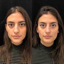 Revision Rhinoplasty