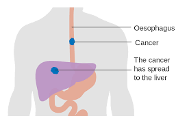 esophageal cancer wikipedia