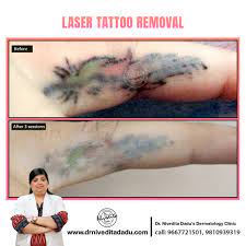 Ultimate guide to treatment prices. Dadu Skin Clinic Twitterissa Concern Unwanted Tattoo How Did We Treat It Laser Tattoo Removal Results After 3 Session Time Taken 4 Months The Area Treated