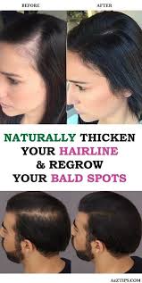 Naturally Thicken Your Hair Line Regrow Bald Spots Regrow Hair Naturally Bald Hair Hair Growth Tips