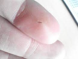 9 Ways To Remove A Splinter Splinter Removal Cleaning Hacks Deep Cleaning Tips