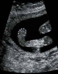 Most clubfeet can be successfully corrected using the nonsurgical ponseti method. Skeleton Diagnosis Of Fetal Abnormalities The 18 23 Weeks Scan Fetal Abnormalities Ultrasound Sonography Diagnostic Medical Sonography