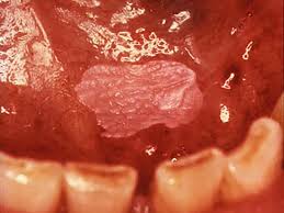 Many tongue problems, such as leukoplakia, white coating or tongue cancer, are associated with poor oral hygiene and unhealthy lifestyle. Leukoplakia Symptoms Causes And Prevention