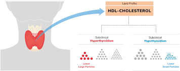 Image result for Subclinical Hyperthyroidism