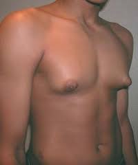 Different people have different symptoms of breast cancer. Male Breast Cancer And Estrogens