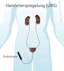 Nieren Und Harnleitersteine Erkrankungen Therapien Urologie Uniklinik Koln