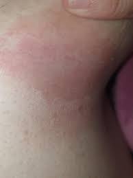 Image result for Candidiasis under breasts