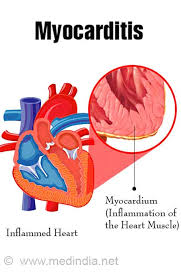 The pathological process is mainly due to the. Myocarditis Types Causes Symptoms Complications Treatment Prognosis