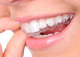 Conventional braces) | how much/often do you need to wear your you'll be expected to wear your invisalign® aligners pretty much around the clock. Invisalign Aligner Faq Invisable Braces Dentist Berlin