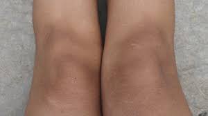 Image result for Pigment stains on the shin