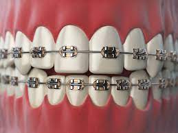 Have at least a moderate need for braces; Dental Braces Their Types And Costs