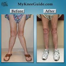 404 Knee Replacement Knee Exercises Knee Replacement Surgery