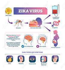 Fever, rash, joint pain, red eyes, muscle pain, headache. Zika Virus Vector Illustration Labeled Mosquito Bite Infection Signs And Symptoms Scheme Epidemic Disease Transmission With Blood Or Pregnancy Danger Congenital Syndrome Birth Defects Warning Royalty Free Cliparts Vectors And Stock Illustration