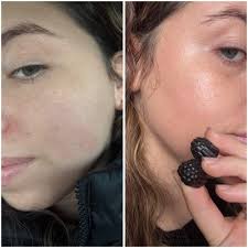 Imarais Beauty De-Puff Anti-Bloat Gummies for Fast Bloating Relief