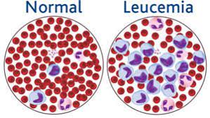 Maybe you would like to learn more about one of these? Medicina Digital Articulo Eliminacion De Celulas Troncales Leucemicas El Modelo De La Leucemia Mieloide Cronica