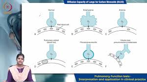 Image result for Diffusing Capacity