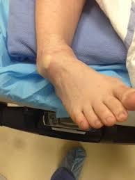 Image result for Ankle Dislocation