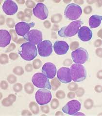 Image result for Acute Leukemia