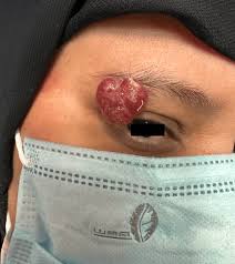 Image result for Pyogenic Granuloma