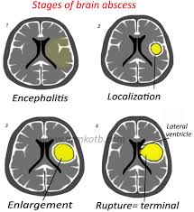 Brain Abscess Stages Home Radiology Brain Tumor Cns