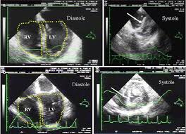 Image result for Cor Pulmonale