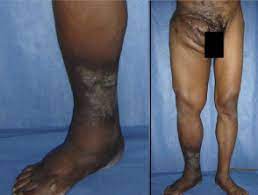 If it begins to spread to other parts of your when a person has foot fungus it will usually attack your skin and nails which are referred to as. Mycetoma Dermnet Nz