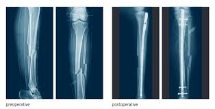 His leg bent sideways, a la shaun livingston. Paul George S Injury Weiss Orthopaedics Orthopedic Surgeons