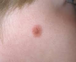 Image result for Spitz Nevus