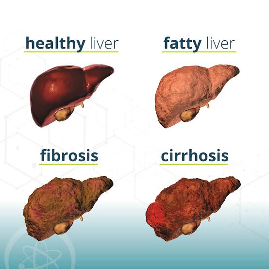 MASH Causes, Symptoms and Treatments - Florida Research Institute