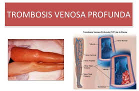 When a blood vessel (a vein or an artery) is injured, the body uses platelets. Trombosis Causas Sintomas Y Tratamiento De La Trombosis Pagina 5 De 5 Guia Medica Familiar