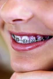 How To Make Brackets For Fake Braces Ehow Fake Braces Dental Braces Diy Braces