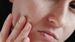 Namun, terus menggaruknya justru akan merangsang rasa gatal pada kulit kepala yang sedang sensitif. Tips Mengatasi Wajah Yang Terbakar Matahari Dengan Bahan Alami Serambi Indonesia