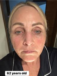 Hi friends. I had a breast reduction about 4 years back for medical  reasons. Now that I am done having kids I am not happy with my chest, or  the unnecessary scarring