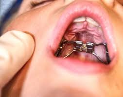 Apr 09, 2021 · adults who are eligible for nhs underbite treatment will pay the band 3 treatment fee. Crossbite Explained