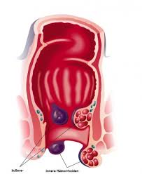 Wenn sie bei sich oder einem ihrer angehörigen die folgenden symptome bemerken, ist eine ärztliche untersuchung ratsam jegliche verfügbaren informationen dienen auf docjones.de dienen der erstinformation und werden insbesondere nicht von approbierten ärzten auf ihre. Hamorrhoiden Ursachen Beschwerden Therapie Gesundpedia De