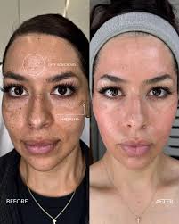 reskn #acnescartreatment #hyperpigmentationtreatment #melasmatreatment  #halolaser #profractionallaser #trlresurfacing #silikonfiller #prpforskin  #chemicalpeel #acnescarhealing #skinrejuvenation…