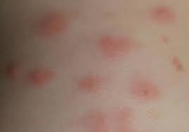 Image result for Papular urticaria