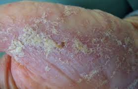 Image result for scabies on genitals