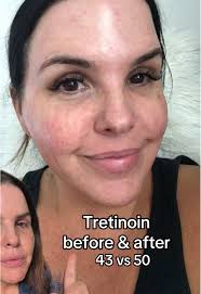 Stieva A Tretinoin Results