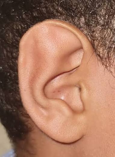 Pre-operative right-sided Stahl's ear Deformity | Download Scientific Diagram