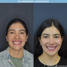 Nueva forma, misma esencia 🙂‍↔️ El resultado de una rinoplastia bien  planificada: natural, armónica y fiel al rostro de cada paciente. Agenda tu  valoración por WhatsApp al 5527532257 o envíanos un mensaje